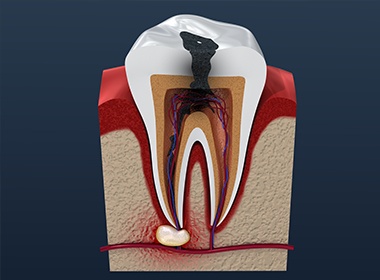 computer illustration of tooth