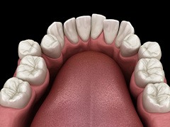 Illustration of crowded teeth