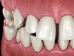 Illustration of gapped teeth