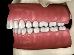 Illustration of an overbite