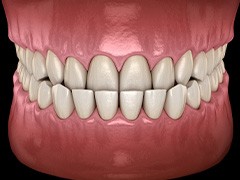 Illustration of an underbite