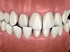 Illustration of a crossbite