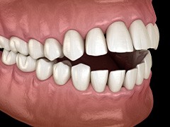 Illustration of an open bite