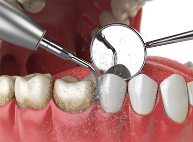 Up-close image of a teeth cleaning