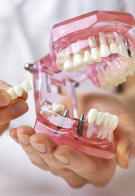 Hands holding model jaw with sample implant bridge