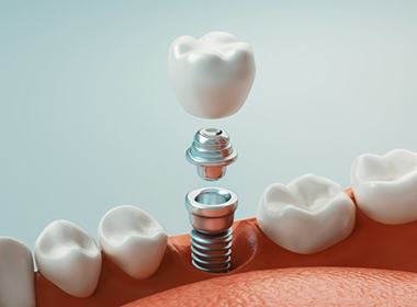 model of how dental implants in Lehigh Valley work 