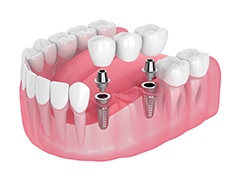 two dental implants supporting a dental bridge 