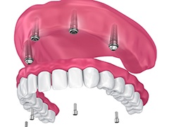 four dental implants supporting a full denture 