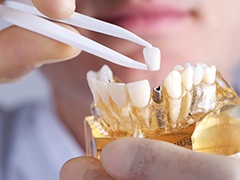 dentist placing a crown on top of a dental implant model 