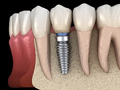 dental implant in the lower jaw 