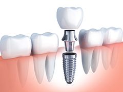 single dental implant with a crown 