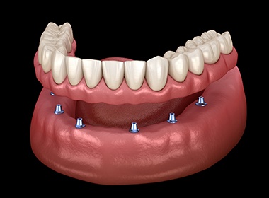Implant dentures are a more secure restoration option than traditional dentures in Coplay, PA