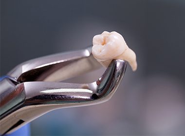 extracted tooth