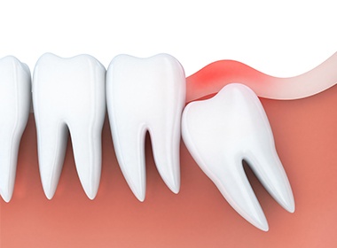 impacted tooth