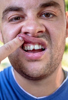 Man lifting up his lip to reveal a chipped tooth