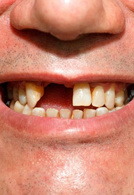 Close up of man’s gap-toothed smile
