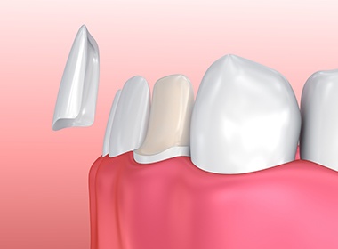prepared tooth