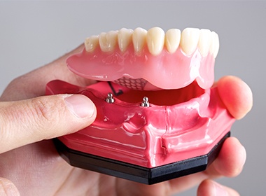 bottom implant denture