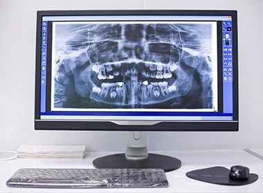 x-ray of whole mouth