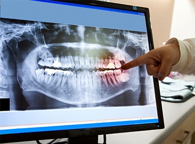 red teeth on x-ray