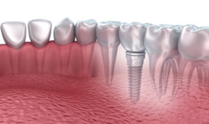 Permanently replace your missing teeth with dental implants in Allentown.