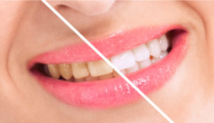 Your dentist in Allentown offers professional teeth whitening treatments.