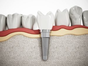 Your trusted dentist provides dental implants near Allentown.