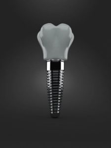 Image of a single dental implant