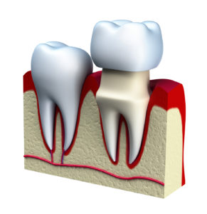 Representation of a dental crown