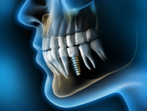 Model of dental implant