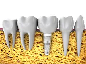 digital image of dental implant