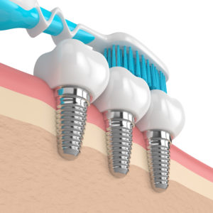 brushing dental implants