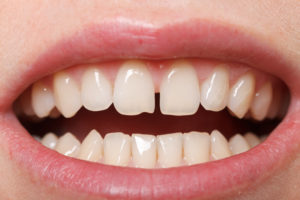 Gaps between teeth