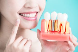 a closeup of dental implants in Lehigh Valley, PA