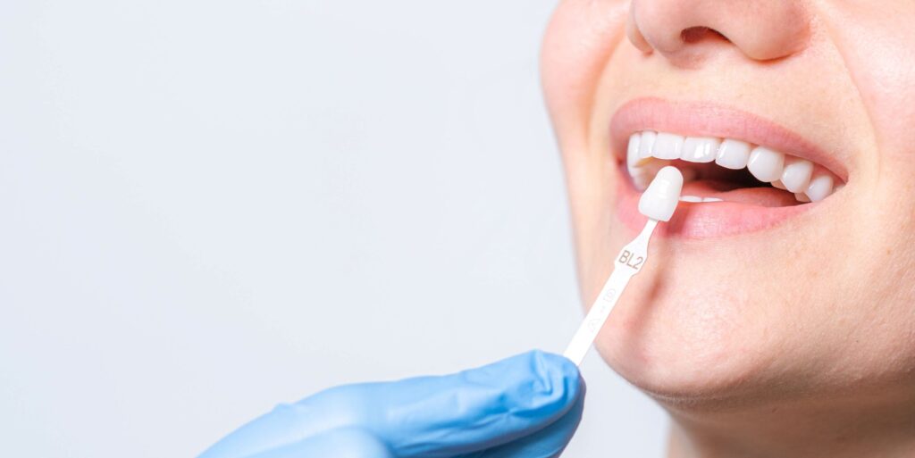 Nose-to-neck view of shade guide held to patient's teeth for veneers